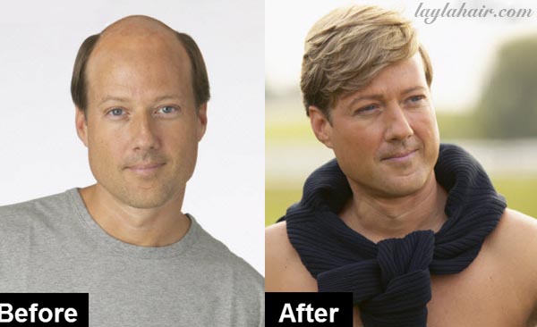 toupee before and after