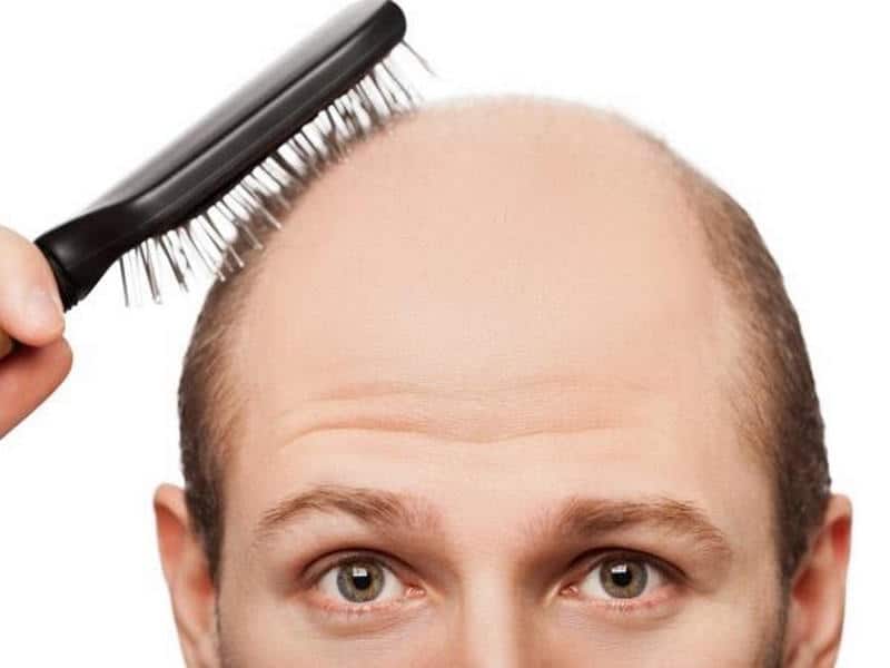 The Practical Hair Fall Problem Solutions For Man