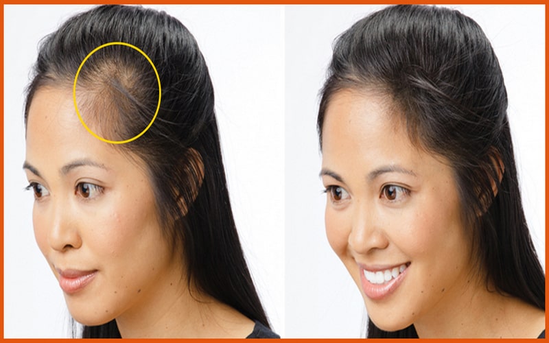 How To Cover Front Hair Loss At Michiko Durbin Blog