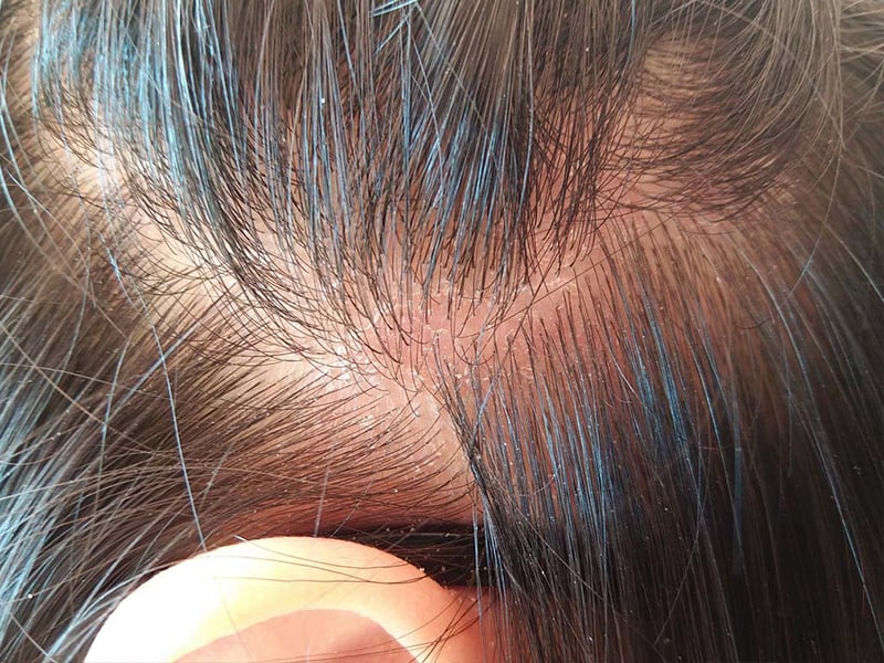 Dry Scalp Treatment: The Failproof Guide For You | Layla ...
