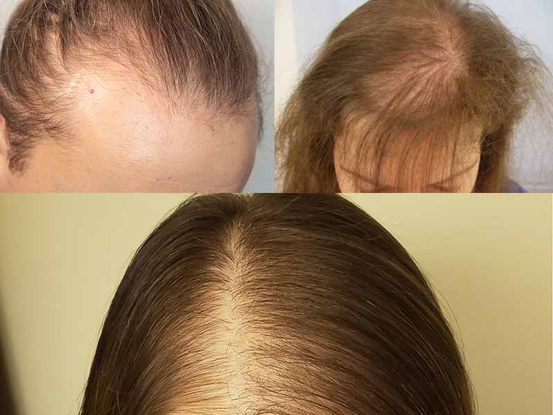 What Is Female Pattern Baldness: Definition, Cause, And Solution