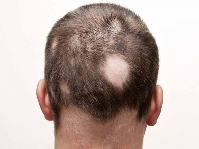 What Is Alopecia Have You Got There The Right Way Layla Hair