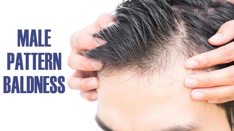 male-pattern-baldness-definition-causes-and-solutions