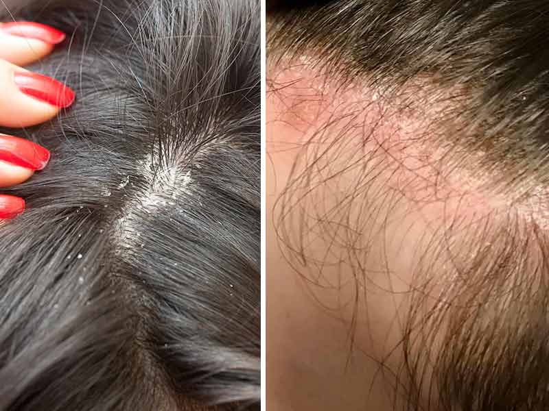 24 2 1 Itchy Scalp Due To Dandruff Or Allergy 