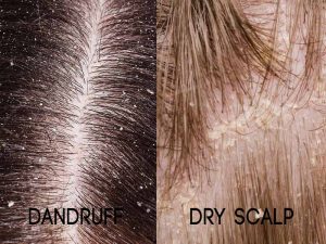 What Is Dandruff? Differences Between Dandruff Vs Dry Scalp - Layla ...