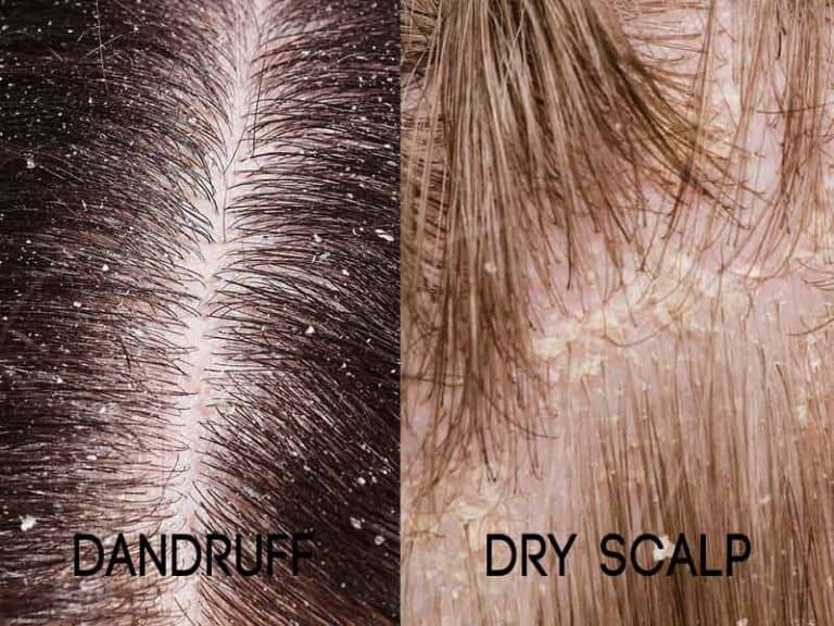 What Is Dandruff? Differences Between Dandruff Vs Dry Scalp