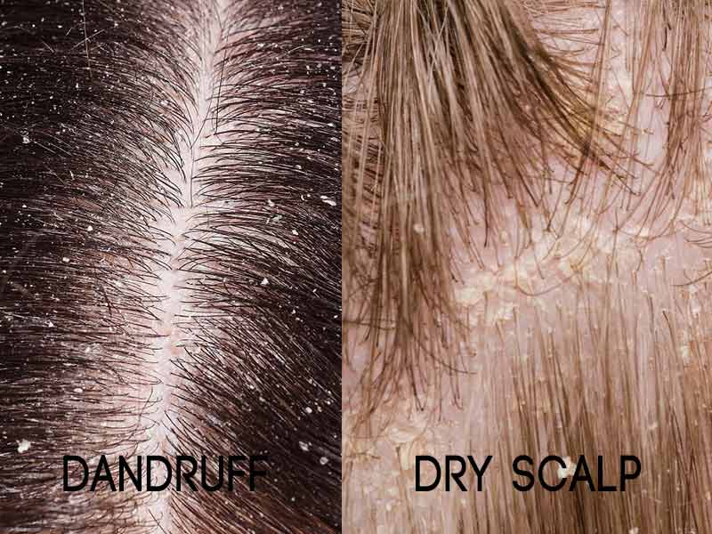 7. "Blonde Hair Powder vs Dry Shampoo: What's the Difference?" - wide 2