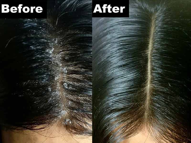 How To Make Use Of Apple Cider Vinegar For Hair? - Learn NOW!