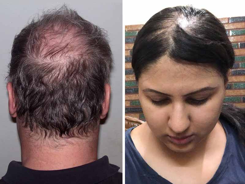 Does Thinning Hair Mean Your Going Bald - Will I Go Bald Calculator