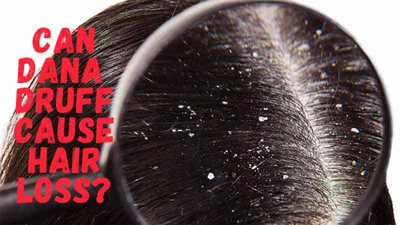 Can Dandruff Cause Hair Loss Statistics And Facts