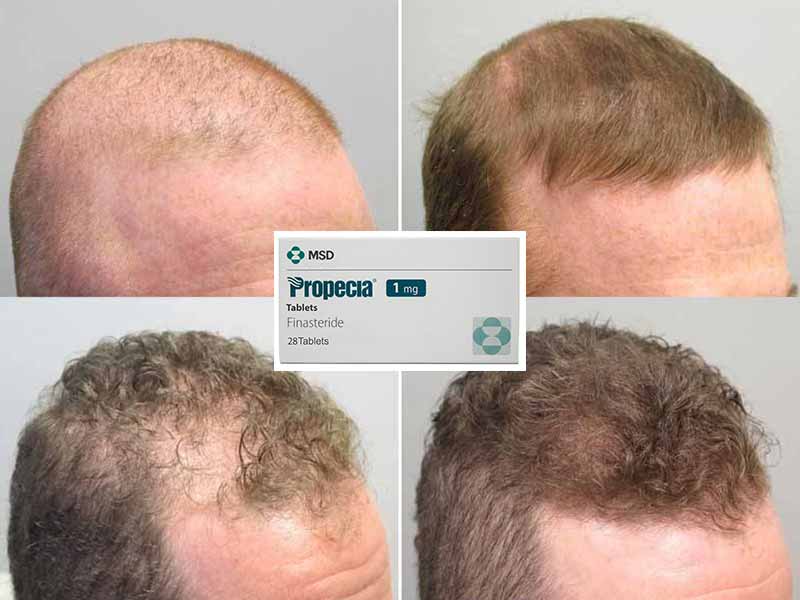 Finasteride For Hair Loss - Is It A Viable Solution? - Laylahair