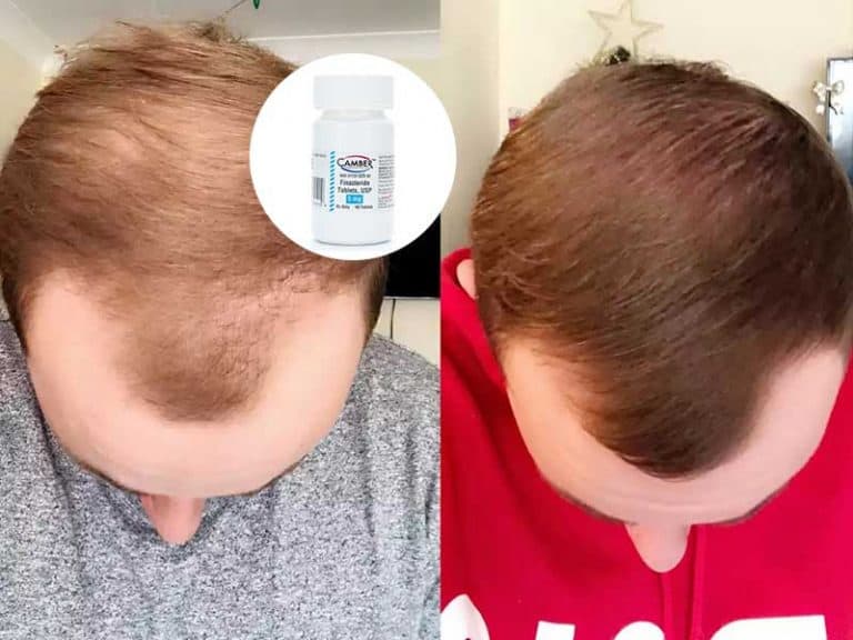 proscar for hair loss side effects