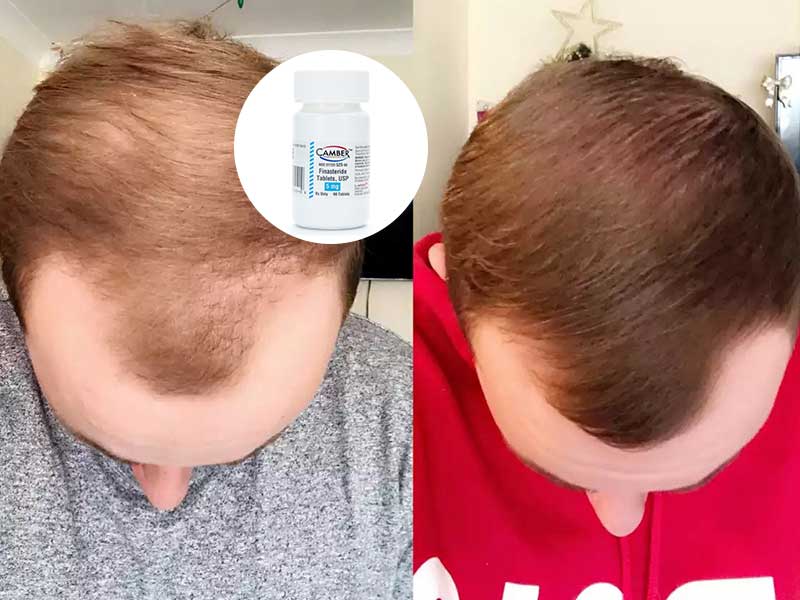does stopping finasteride accelerate hair loss