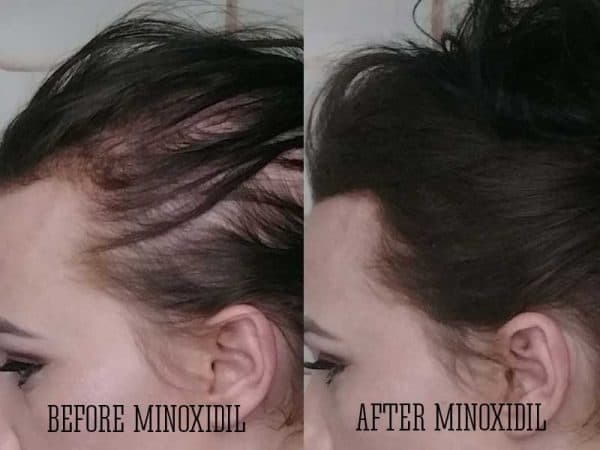 Get The Scoop On Minoxidil For Hair Loss Right Now | Lewigs